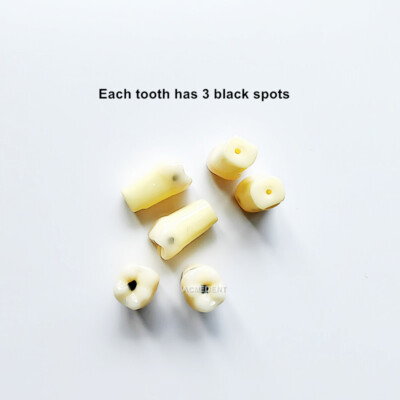 Dental Molar Vitro Teeth Decay Caries Tooth Model Dentist Student Practise Test