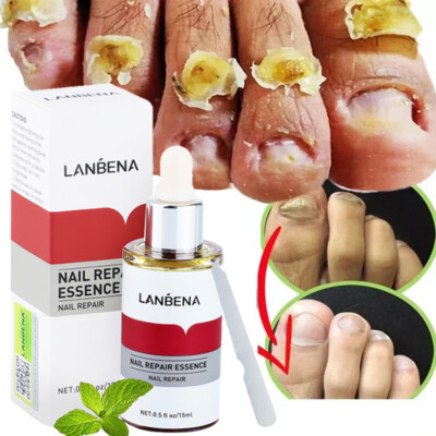 LANBENA Nail Repair Essence Oil Remove Onychomycosis Serum Fungal Nail Treatment