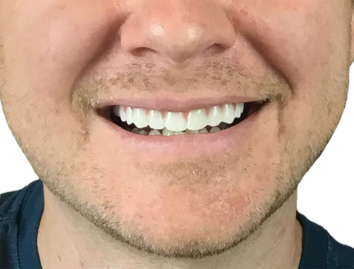 Instant Smile Comfort Fit Flex - Natural Shade - Upper Veneer