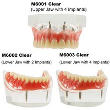 Dental 2/4 Implant Overdenture Restoration Upper Lower Teeth Model Typodont