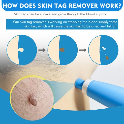 Auto Micro Skin Tag Remover Device Kit Safe Painless Removal 2-8 mm Band Tool - Picture 7 of 33