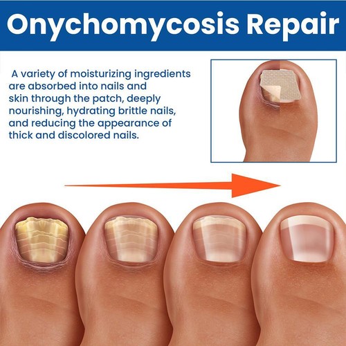 60pcs Anti Fungal Nail Treatment Patches Toe Fungus Onychomycosis Repair best - Picture 5 of 12