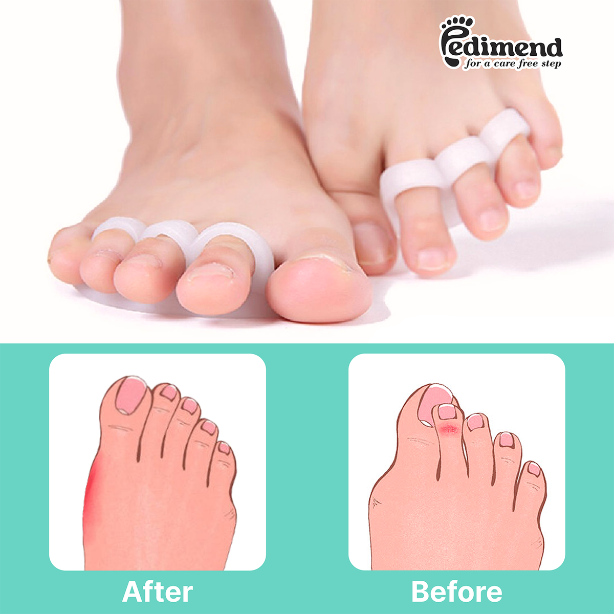 PEDIMEND™ Hammerzehen-Glätteisen Aus Silikongel - Zehenspreizer Für