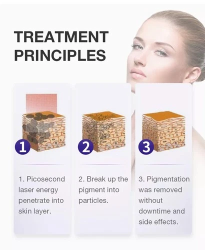 Picosecond Q-Switch ND Yag Laser Machine Pico Laser Tattoo Removal Machine image 8