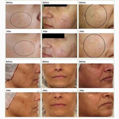3in1 Facial O2 Co2 Bubble Oxy-gen Treatment R-F Spa Machine Anti-aging Skin Care - Picture 9 of 36