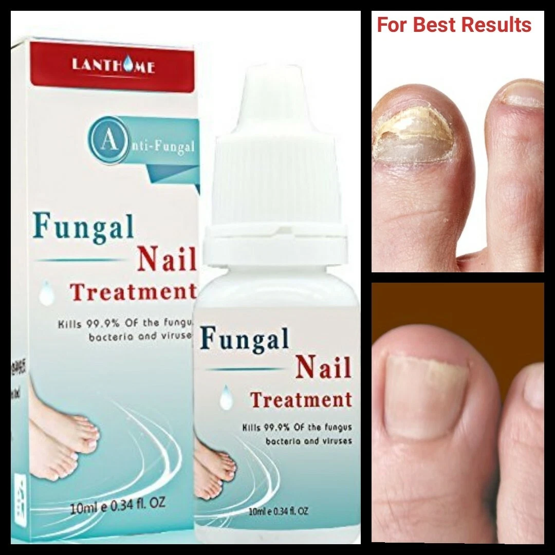 Update more than 172 best fungal nail treatment amazon ceg.edu.vn
