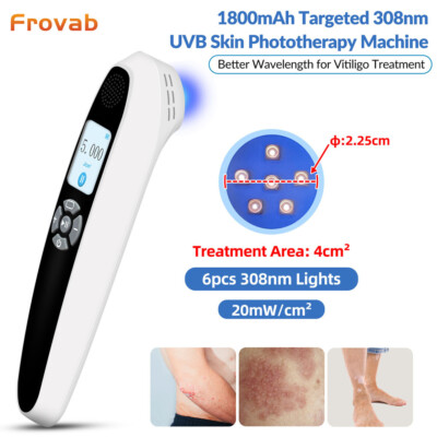 Frovab 308nm Excimer System Home UvbLight Phototherapy Device for Skin Treatment