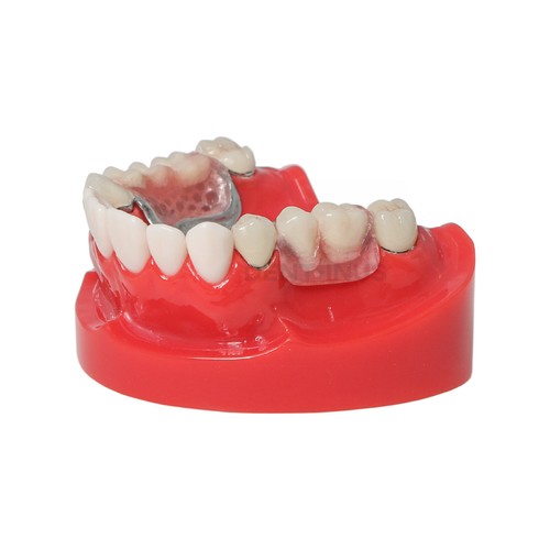 Modelo de dientes tipodonte dental con telescopio corona prótesis dientes modelos M6010 - Imagen 4 de 7
