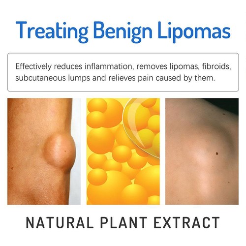 US-Lipoma Soothing Cream Instant Ointment Relieving DiscomfortFat Agglomera best - Picture 9 of 12