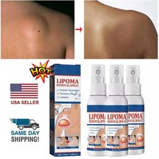 1-5PC Lipomheilung Reduction Spray,Instant LumpFree Lipoma Removal Spray USA Hot
