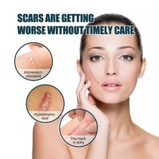 Silicone Scar Removal Sheet: Heals Burns, Acne,  Stretch Marks