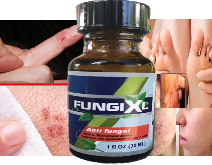 Ointment gel Anti-Fungal SALICYLIC & BENZOIC COMPOUND ECZEMA Wart Antifungal - Image 4 of 4