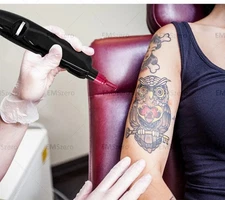 Q-switch Picosecond Non-invasive, Hot Selling Laser Tattoo Pigment Removal