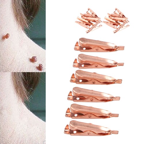 Skin Tag Remover Clips Safe Copper Smooth Skin Tag Removal Tool For Face L2S - Picture 19 of 29
