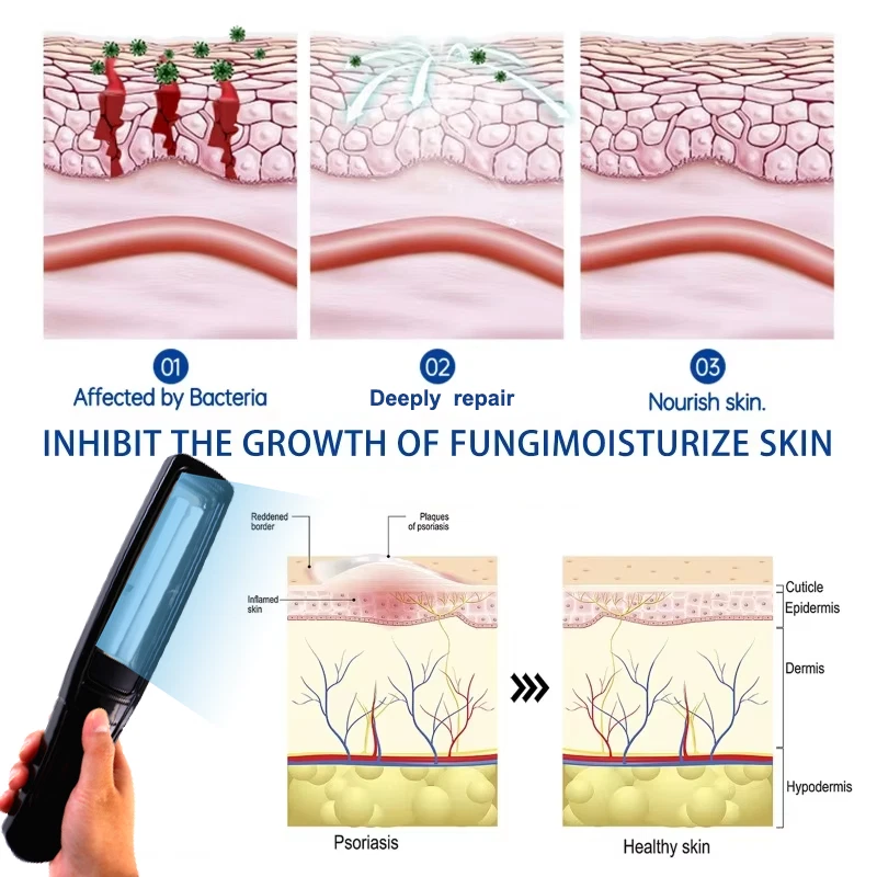 Dispositivo Fototerapia UVB 311nm Philips Psoriasi Vitiligine Portatile CE - Immagine 4 di 4