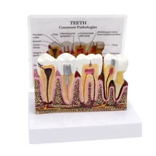 Human Periodontal Pathologies Teeth Model Anatomical Detachable Tooth Model USA