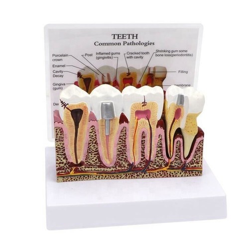 Human Periodontal Pathologies Teeth Model Anatomical Detachable Tooth Model USA - Imagen 1 de 11