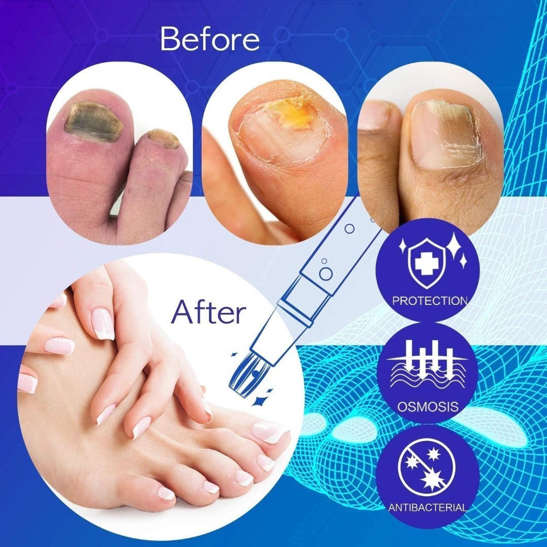 Pluma Tratamiento Hongos Uñas Pies Manos Gel Reparador 3ml Pack de 4