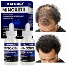 2x 50ML Minoxidil 5% Topical Solution for Men Hair Regrowth, Hair Loss Treatment