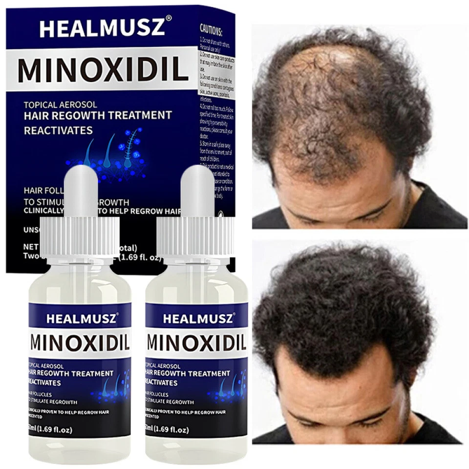 HEALMUSZ Minoxidil 5% Extra Fuerza Hombres 4 Meses Suministro Solución para el Crecimiento del Cabello Foto 2 de 4