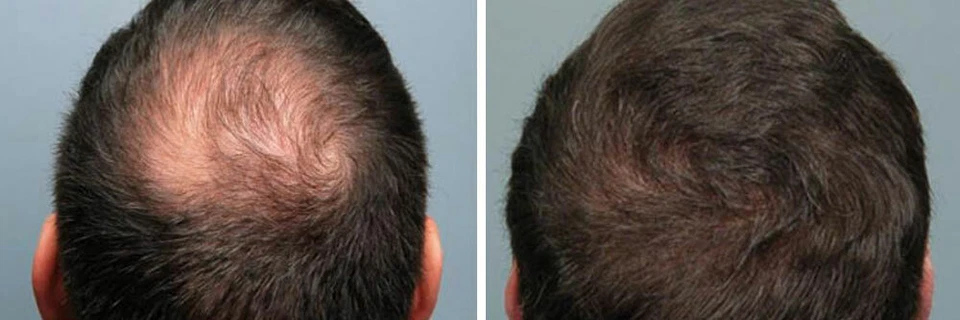 Best Hair Loss ReGrowth Serum Oil Treatment with 16 Organic Oils Men and Women - Image 4 of 4