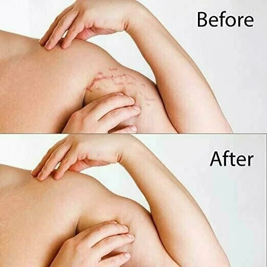 Mederma Stretch Marks Therapy Advanced Cream Formula, 5.29 Oz Brand New, No Box - Image 2 of 4