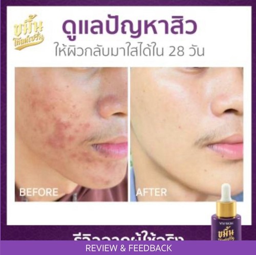 Turmeric Gold Serum Reduce Acne Dark Spot Wrinkles face 14 ml - Picture 19 of 23