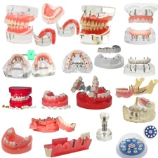 Dental Implant Model Upper Lower Jaw Demo All on 4/6 Overdenture treatment model