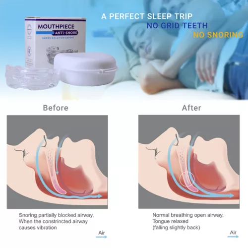 Dream Mouth Guard Custom Anti Snoring Device Mouthpiece Sleeping Aids Stop Snore - Picture 8 of 12