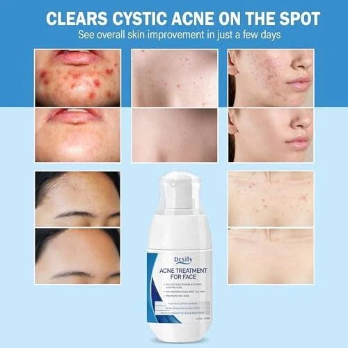Tratamiento de acné facial Dcsily 1,7 fl oz - ácido salicílico - aceite de árbol de té - aloe Foto 2 de 4
