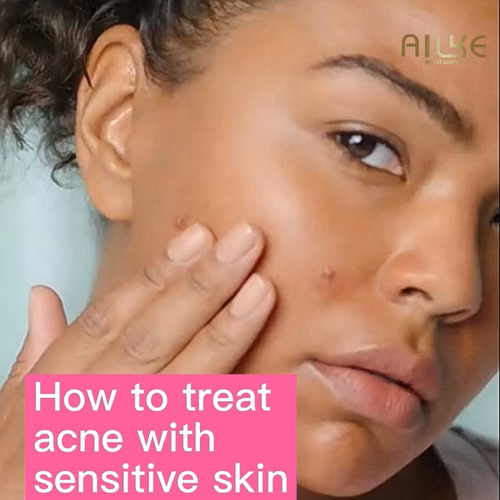 Acne Treatment Cream with Salicylic Acid/ Clears Pimples and Blemishes - Video 1 of 1