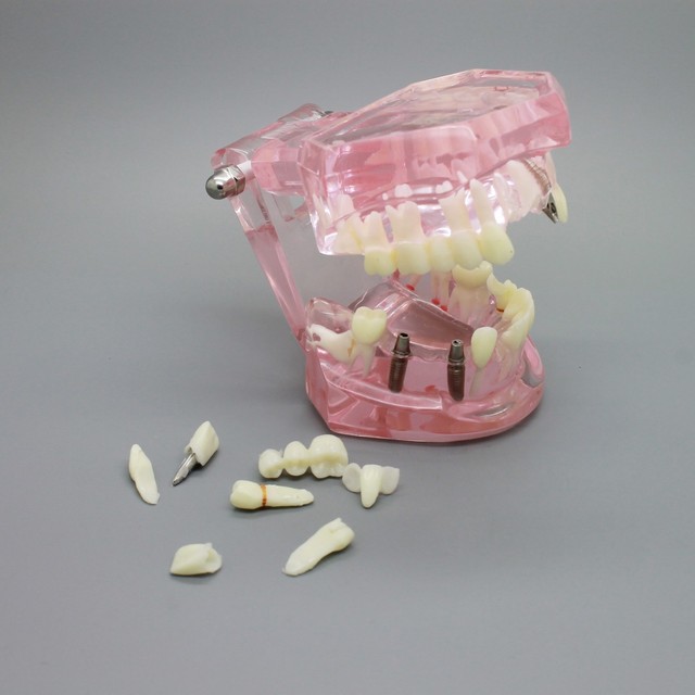 Dental Pink Implant Analysis Demonstration Teeth Disease Model with