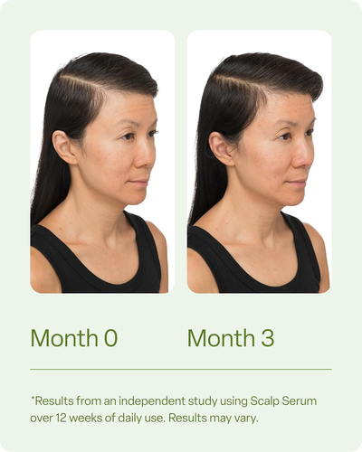 Scalp Serum for Thinning Hair, 30ml – Clinically Tested, Nourishing Formula with - Picture 5 of 12