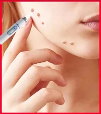 Warts Removal Pen Skin Care Mole Tag Remover Laser Dark Spot Wart Foot