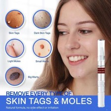 1Pcs Common and Plantar Moles-Off Remover, WipeOff Tags Moles Remover NEW