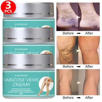 SXIAGNIAN 3~Varicose Veins Miracle Cream Vasculitis Legs Treatment Skin Ointment Foot Care