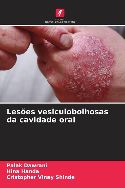 Palak Dawrani (U. A.) | LesõEs Vesiculobolhosas Da Cavidade Oral | Taschenbuch-image