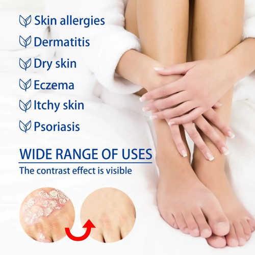 Psoriasis Dermatitis Ekzem natürliche Creme Hautbehandlung Salbe KOSTENLOSER VERSAND - Bild 4 von 14