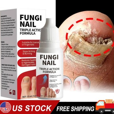 Fungi-Nail Anti-Fungal Liquid Solution Kills Fungus That Can Lead To Nail