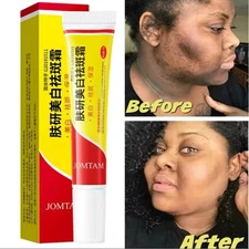 Skin Renewal Face Cream, Melasma Cream, Pigmentation Removal Cream, Dark Spot