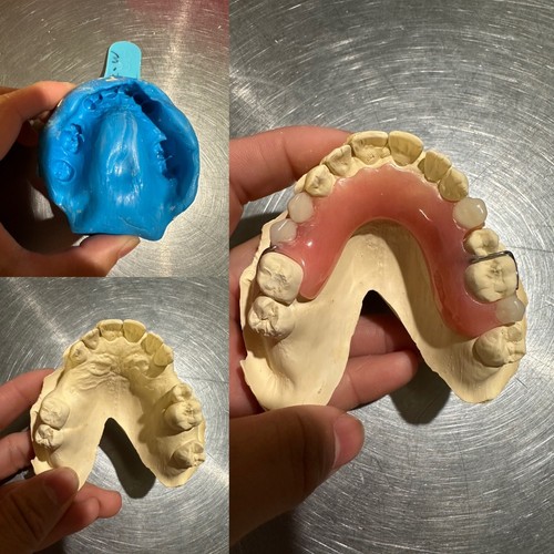 CUSTOM MISSING TEETH FLIPPER/ StayPlate for Upper Lower (Hard Acrylic