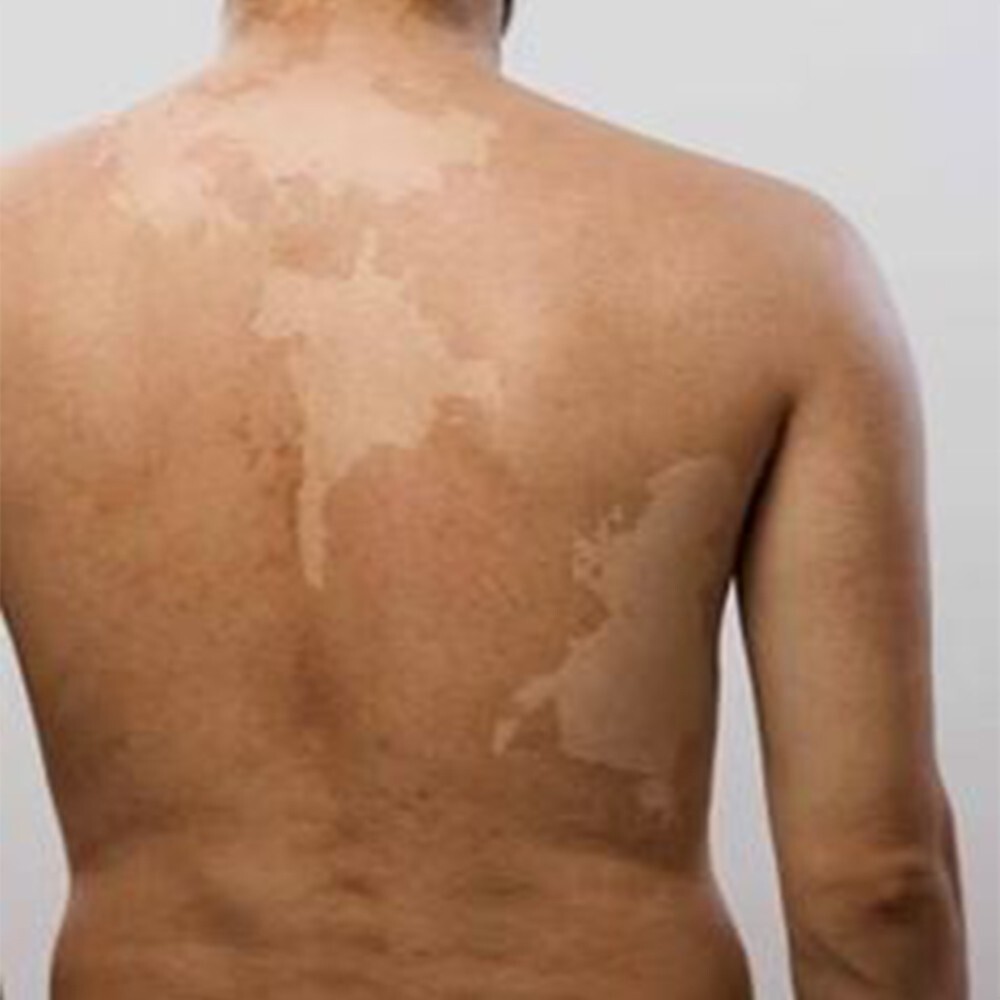 Skin Rashes And Diseases Eczema Itch Tinea Versicolor Prickly Heat ...