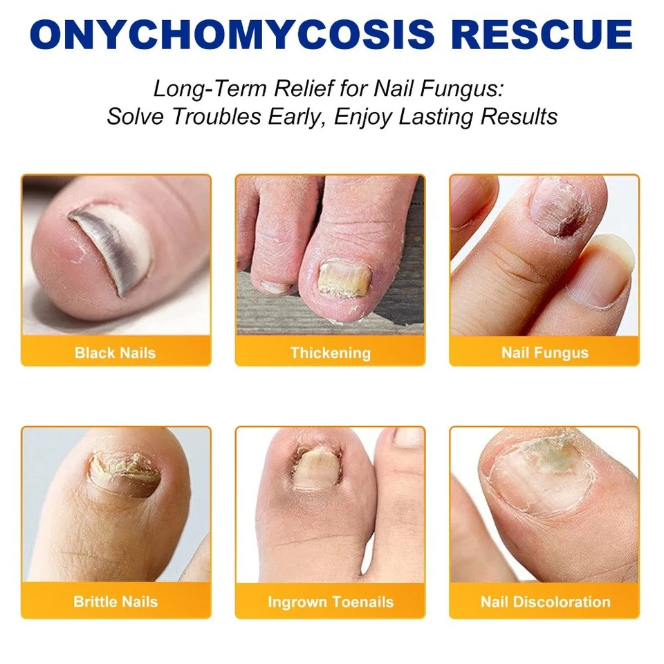 Parches de uñas para hongos 64 piezas - Tratamiento de hongos en las uñas de los pies extra fuerte durante la noche Foto 4 de 4