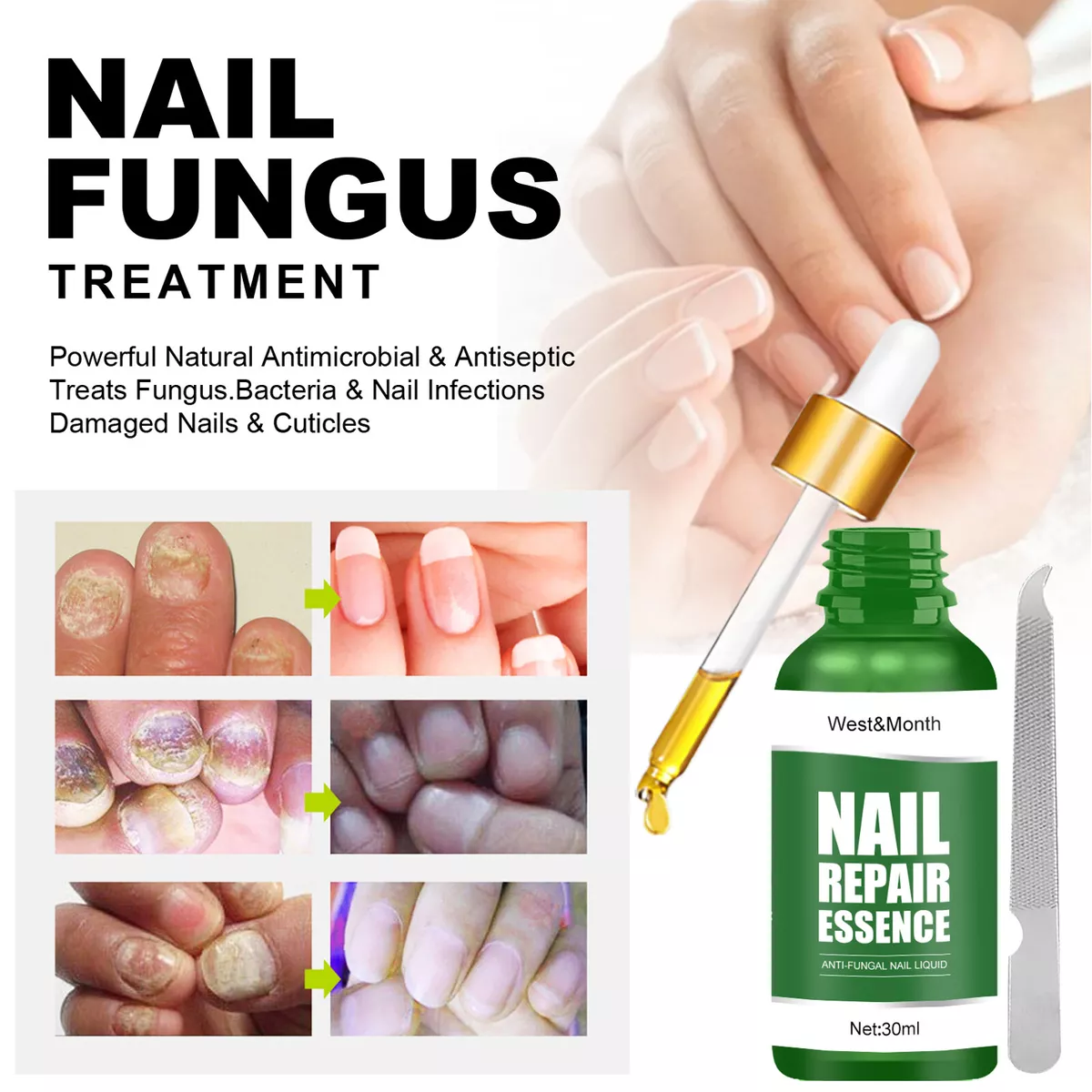 Amazon.com : Bestkiss Toenail Fungus Treatment Extra Strength: Nail Fungus  Treatment for Toenail and Fingernails-Fungus Nail Treatment w/ Liquid 15ML  and Antifungal Nail Repair Cream 20G-Plant Extract Ingredients : Health &  Household