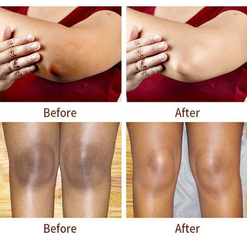 Dark knuckle Skin Whitening lightening Kojic acid, Glycolic acid, Fade CREAM 50g - Picture 4 of 4