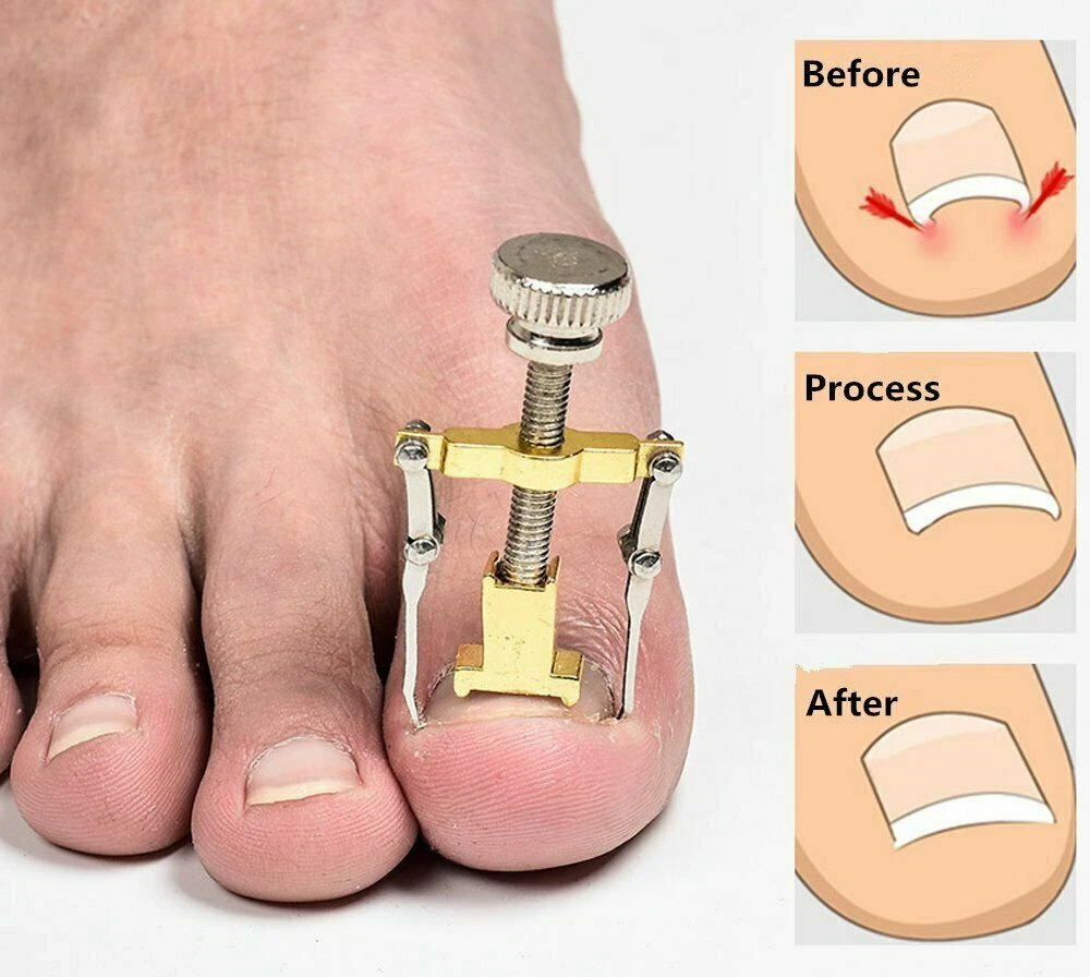 Ingrown Toe Nail Treatment Ingrowing Correction Pedicure Tool Fungal Toenail Kit