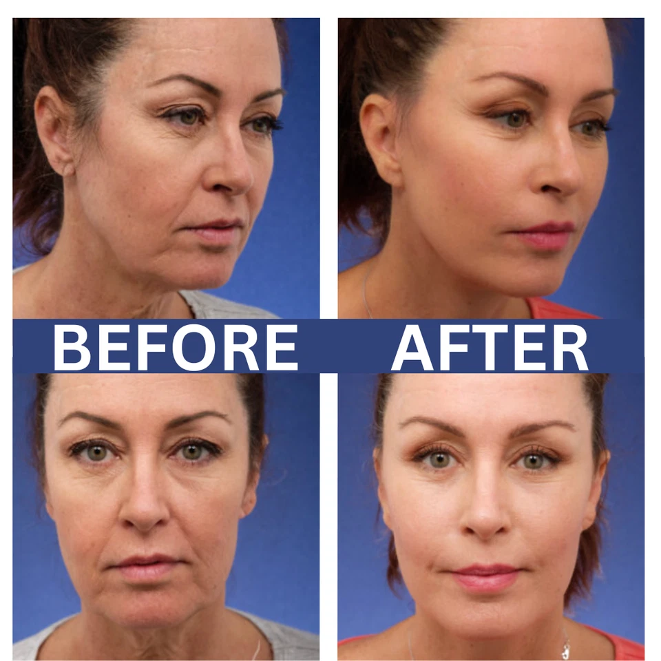 2 Pk - Matrixyl 3000, Argireline Hyaluronic Acid AntiAging Wrinkle SERUM + CREAM - Image 4 of 4