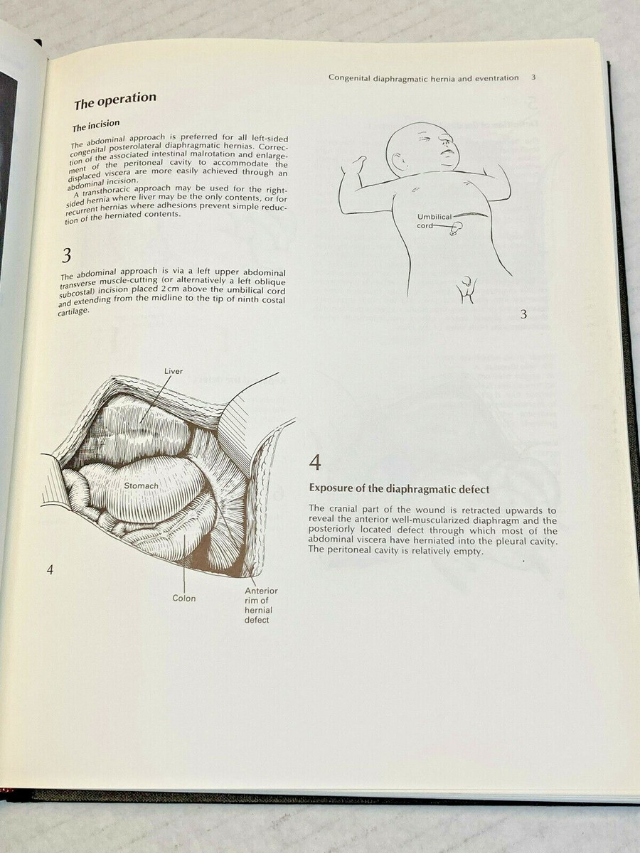 Rob & Smith's Operative Surgery Thoracic & Cardiac Surgery 2