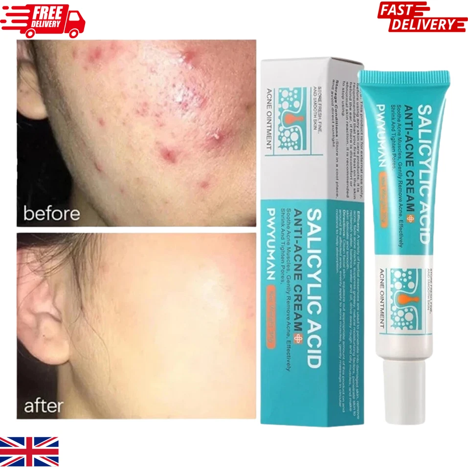 BRANDED Salicylic Acid Strong Acne Removal Cream Anti Acne Pimple Scars Spots Clean Uk