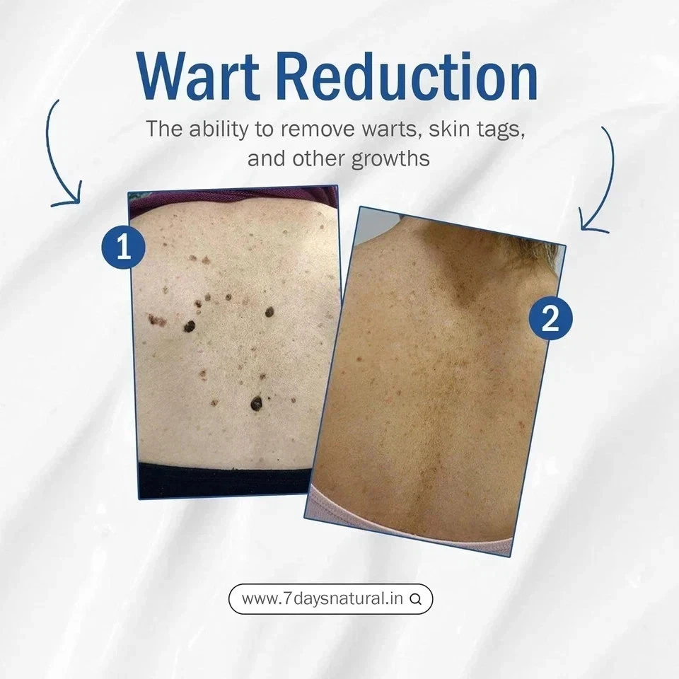 Crema tratamiento eliminación de verrugas genitales. Embalaje discreto gratis incluido 50g. Foto 3 de 4